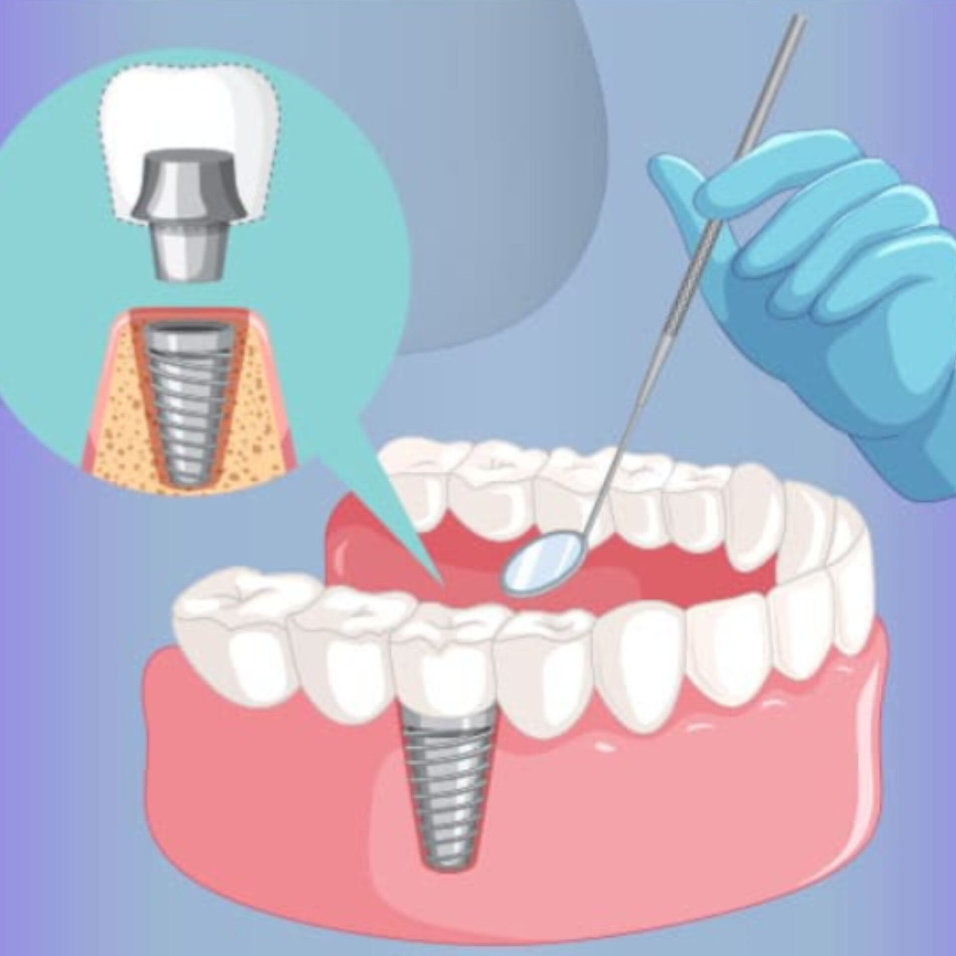 سؤالات پرتکرار ایمپلنت دندان (بخش پنجم)