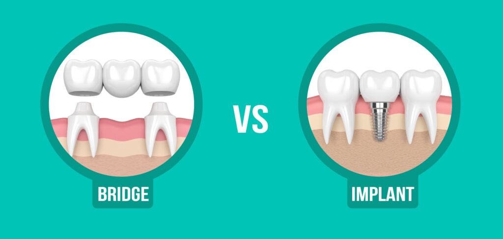 ایمپلنت بهتر است یا بریج؟