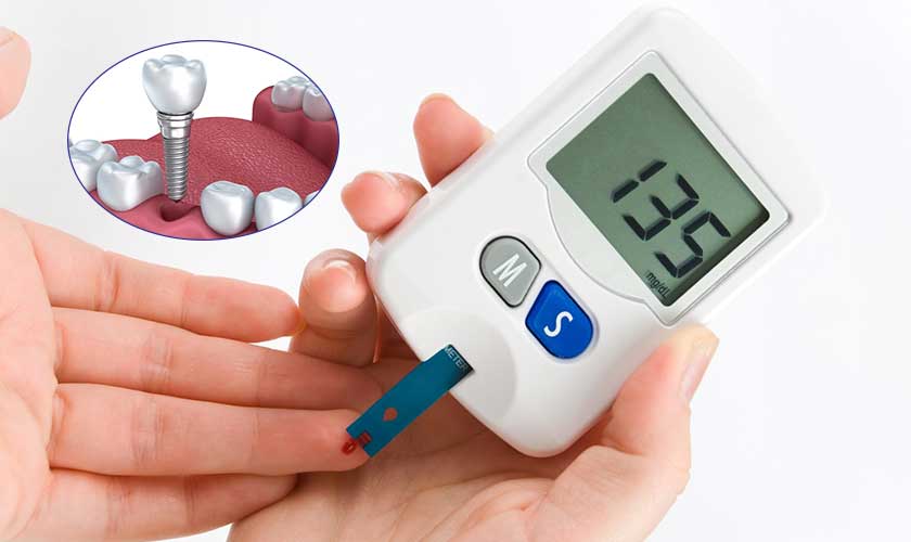 آیا افراد دیابتی می‌توانند ایمپلنت دندان انجام دهند؟